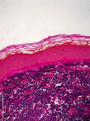 Actual Sun Damage. Microscopic view. EVG stain showing solar elastosis (sun Damage) of dermal collagen resulting in the black appearance on this stain. Normal fibers should appear red. photo