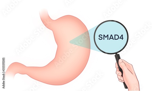 Variants of the SMAD4 gene are associated with an increased risk of developing stomach cancer