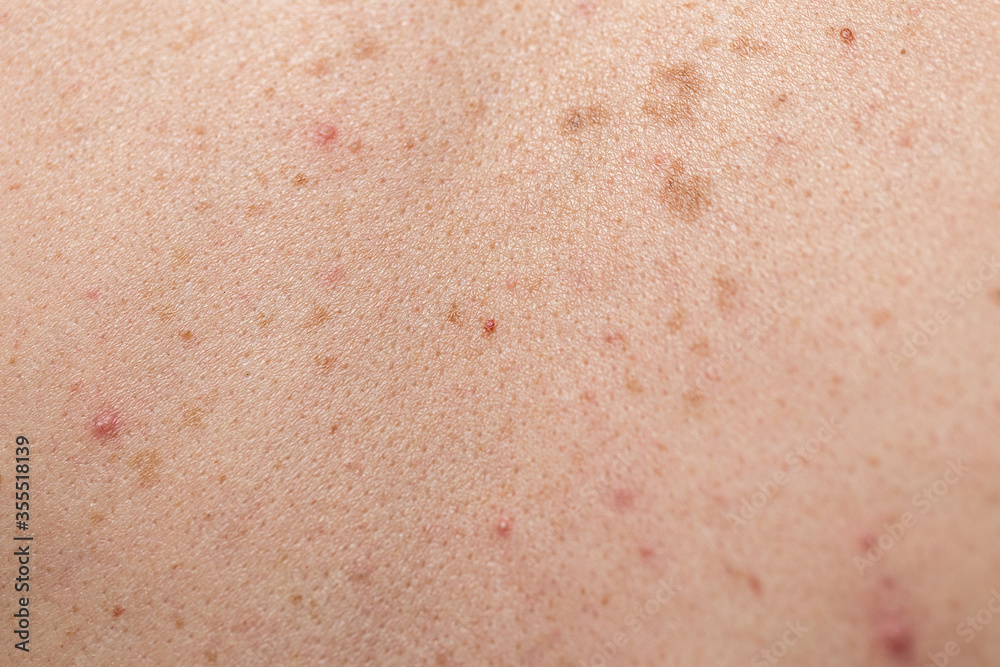 Fototapeta premium Close-up of large rashes or smallpox on the skin of an adult male. Pigmented spots on the back of a man. Skin of a man with moles. Acne.