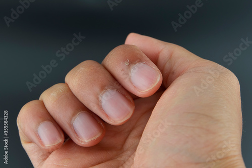 Finger with hangnail isolated on black background. photo