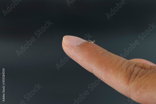 Finger with hangnail isolated on black background. photo