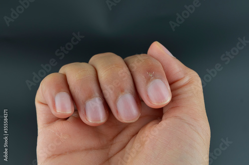 Tableau sur toile Finger with hangnail isolated on black background.
