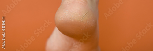 Close-up lower part male foot, heel with crack. Health skin on legs. Dermatological problems on legs men. Cosmetic and spa treatments for men. Dehydration is reflected in skin body.