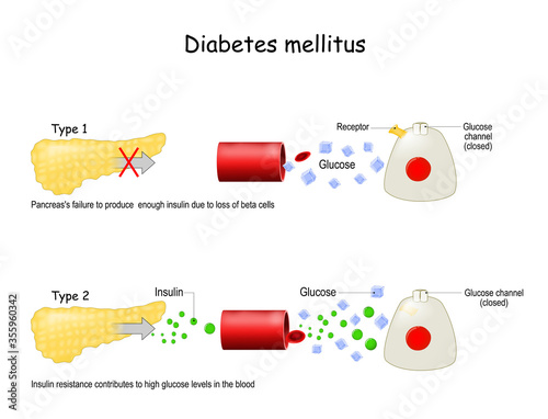 Types of diabetes mellitus.