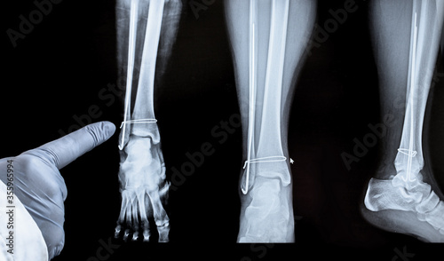 X-ray of the leg after surgery