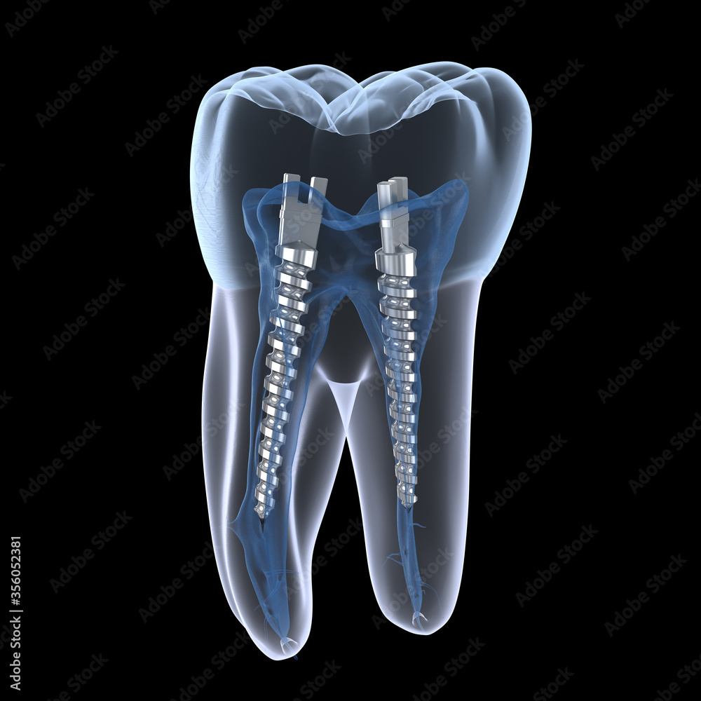 Dental steel post inside molar teeth, Xray view. Dental endodontic