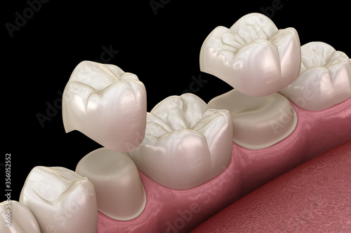 Fototapeta Naklejka Na Ścianę i Meble -  Porcelain crowns placement over premolar and molar teeth. . Medically accurate 3D illustration