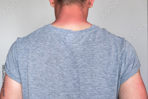 Принти на полотні a man in a gray T-shirt with sunburned skin on his arms and neck