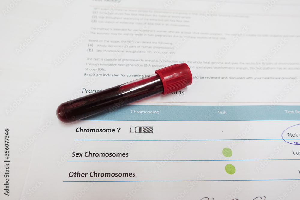 Blood for chromosome testing in laboratory Blood for chromosome testing in laboratory