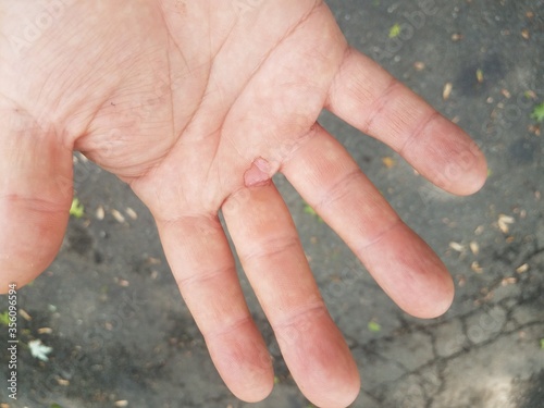 palm of hand with popped blister