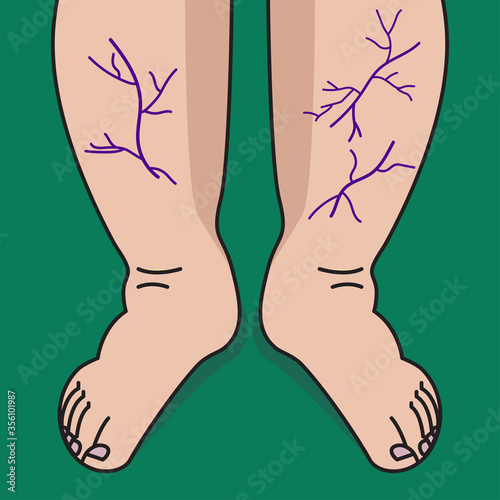 Varicose veins on legs of woman