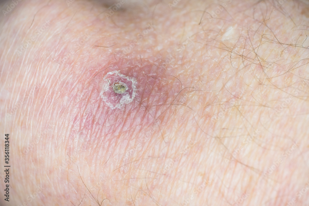 Skin healing of a pimple on the knee of a human. Narrow depth of field