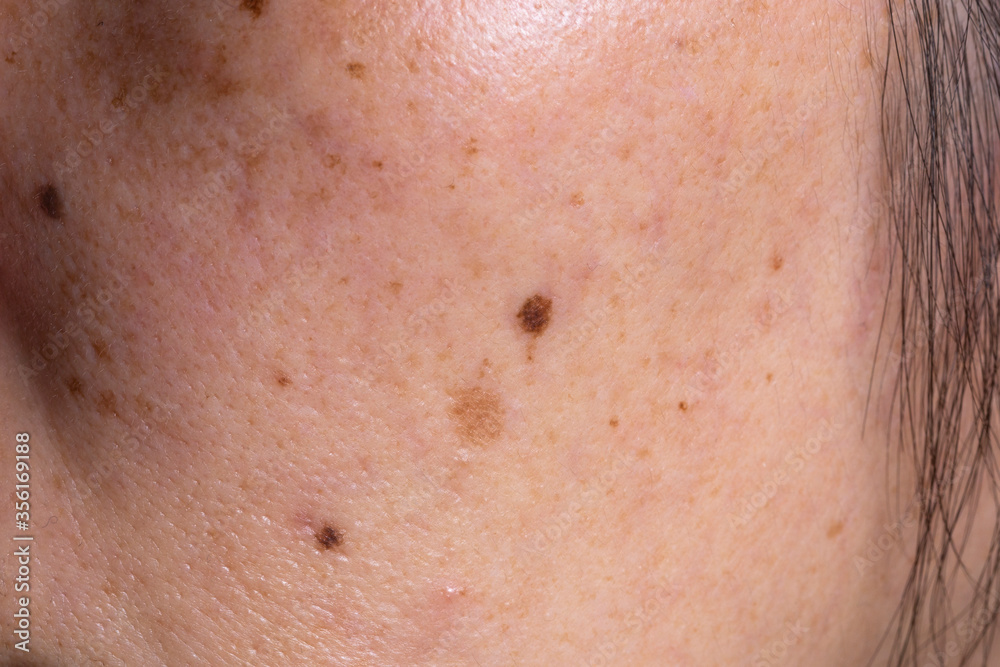 Close-up of spots and blackheads on the face