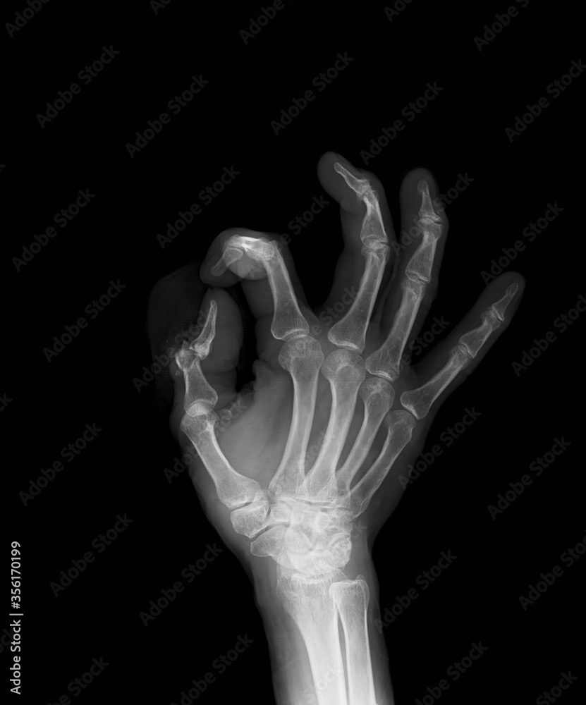 X-ray image of right hand, oblique viwe, showing tumd bone fracture. X-ray image of right hand, oblique viwe, showing tumd bone fracture.