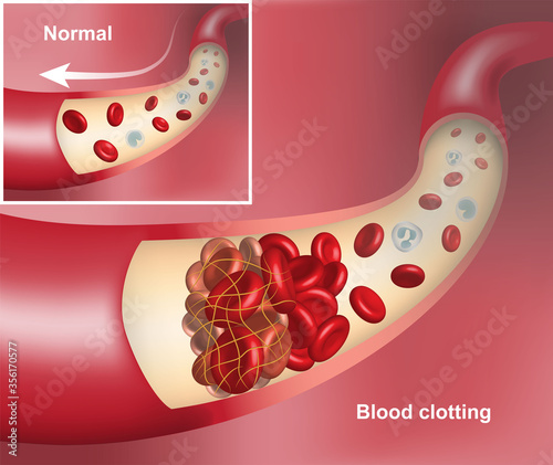 3D illustration of human blood vessel with a forming blood clot versus normal blood flow
