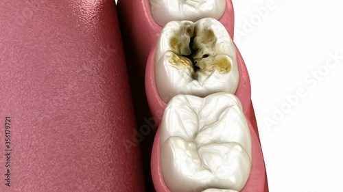 Dental onlay ceramic crown restoration. Medically accurate 3D illustration of human teeth treatment photo