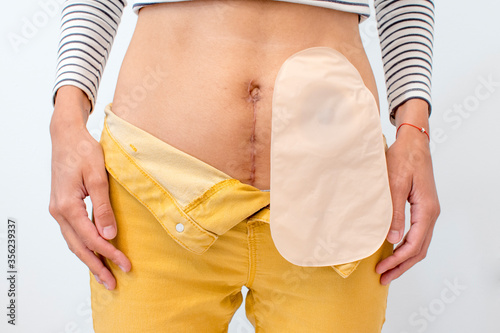 Colostomy bag on person, person with scar, front view of person