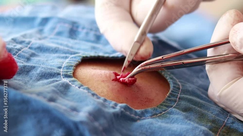 Extracting lipoma in man's back in ambulatory surgery in selective focus