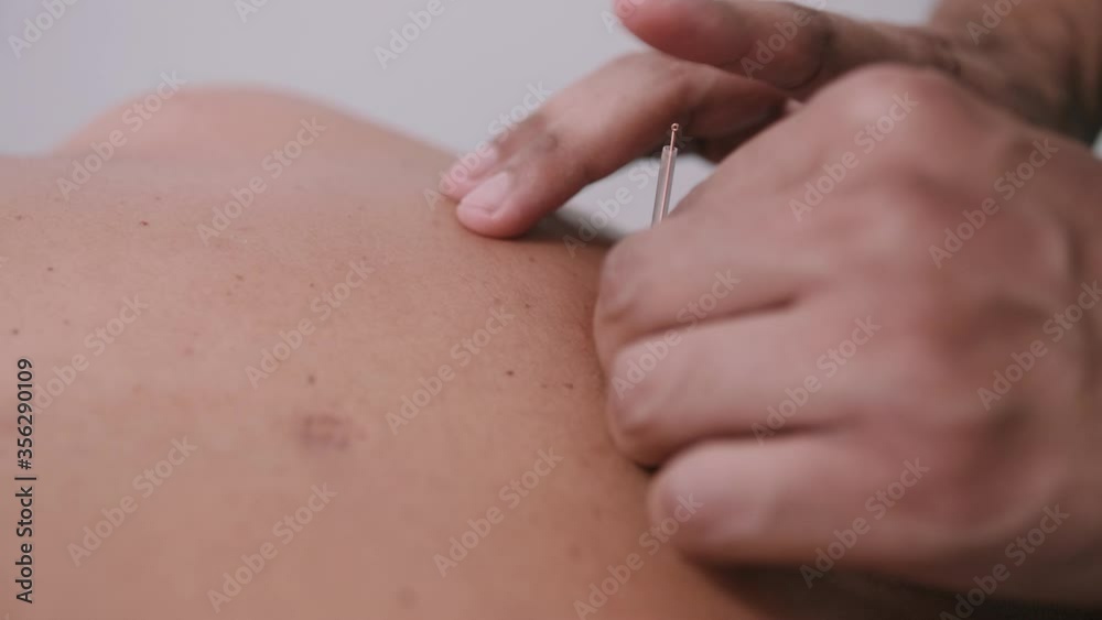 Acupuncture close up, needles being put into skin Acupuncture close up, needles being put into skin