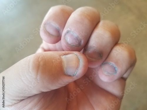 Tela bitten and dirty fingernails