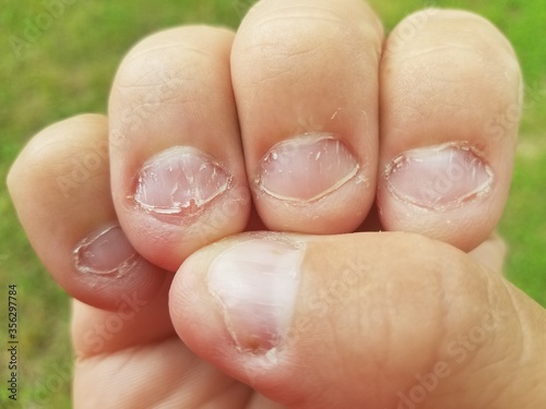 bitten fingernails © Justin