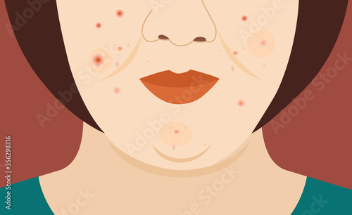 Allergy rash and red blister acne on woman face closeup vector illustration
