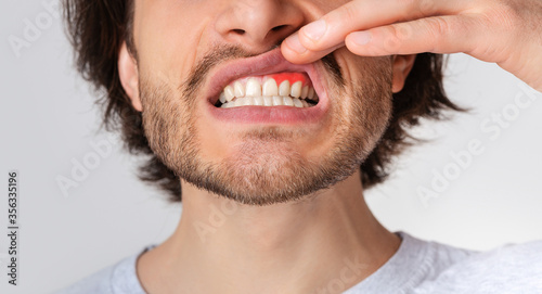 Gingival inflammation and dental problems. Guy pushes his lip up and shows red gum photo