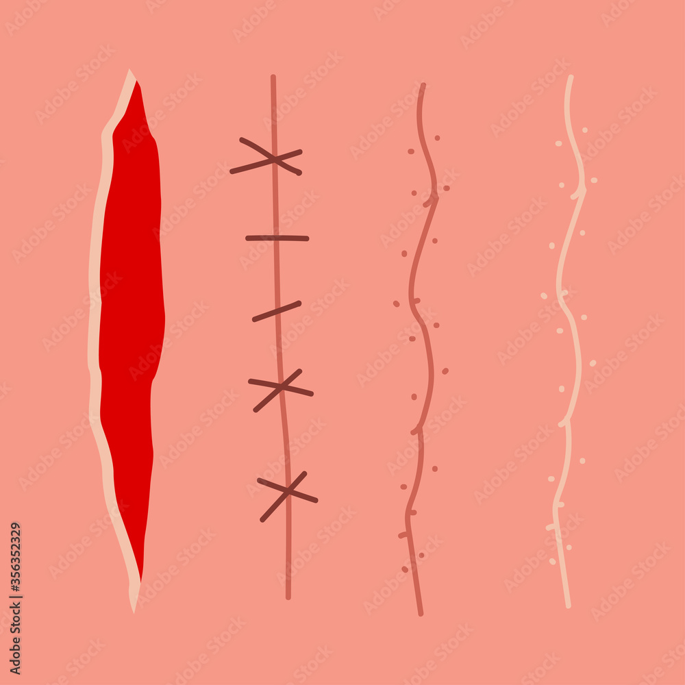 Scar, wound, incision, suture vector set isolated on background. Stock