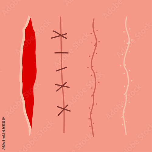 Scar, wound, incision, suture vector set isolated on background.