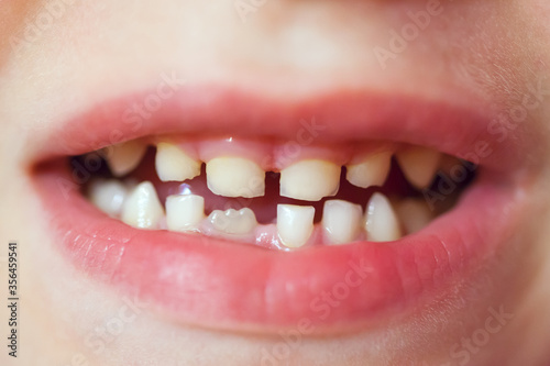 Close up child caries
