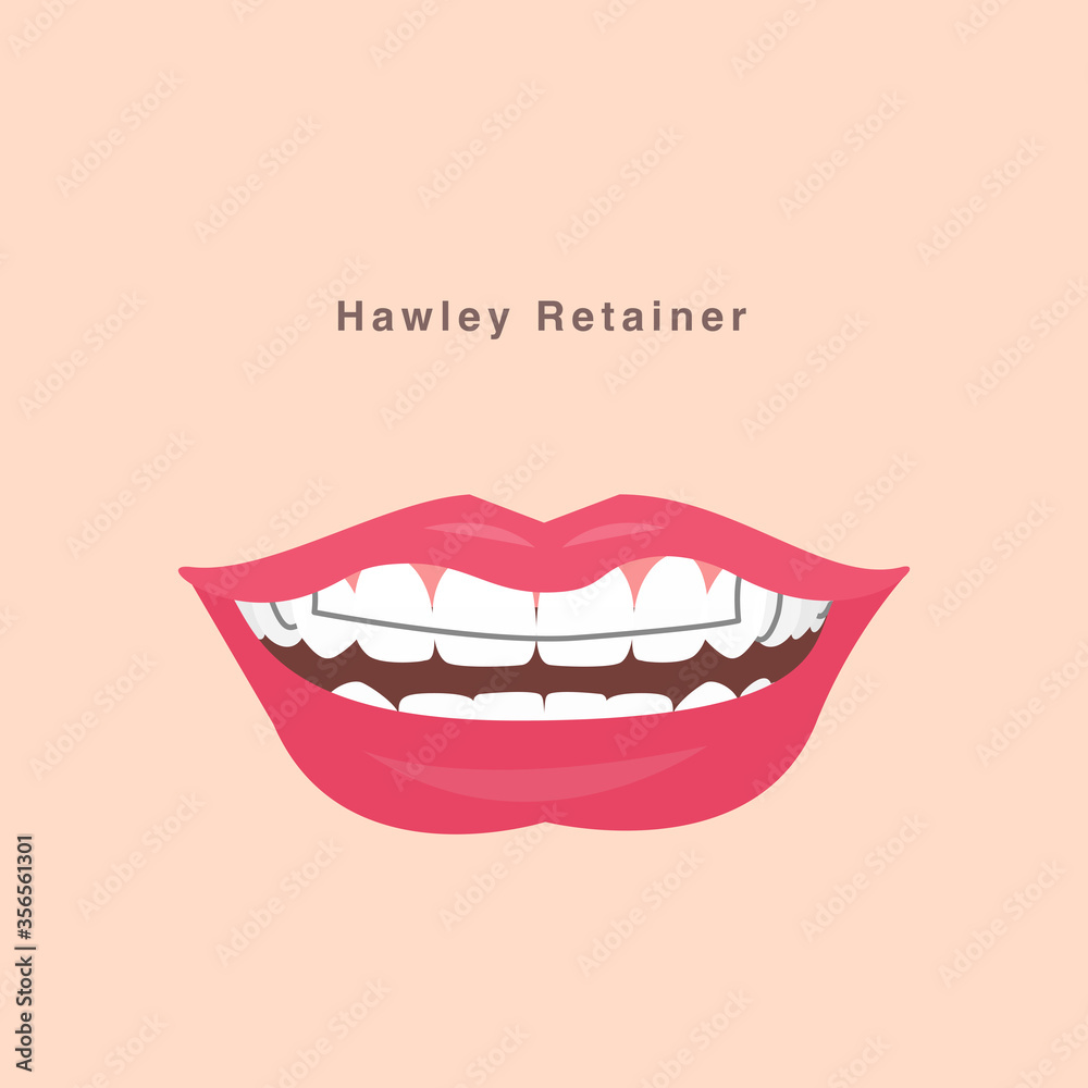smile with hawley retainer smile with hawley retainer
