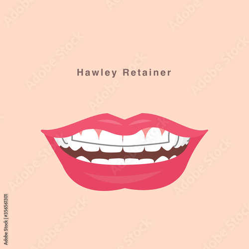  smile with hawley retainer