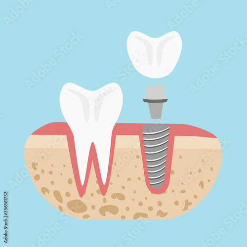 Dental implant