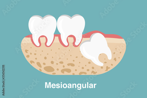 Wisdom tooth ( Mesioangular impaction ) illustration Vector.