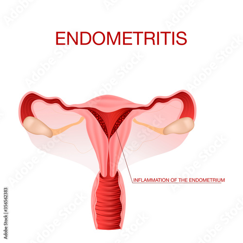 Uterus affected by endometriosis. Inflammation of the uterus. Infographics Vector illustration on isolated background.The concept for medical publications.