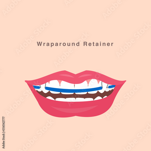 smile with wraparound retainer