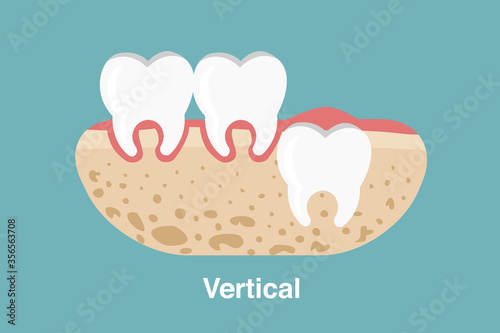 Wisdom tooth ( Vertical impaction ) illustration Vector.