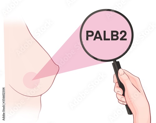 Variants in the PALB2 gene are associated with an increased risk of developing breast cancer