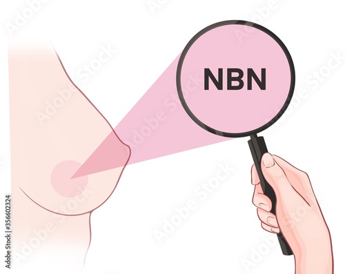 Variants in the NBN gene are associated with an increased risk of developing breast cancer