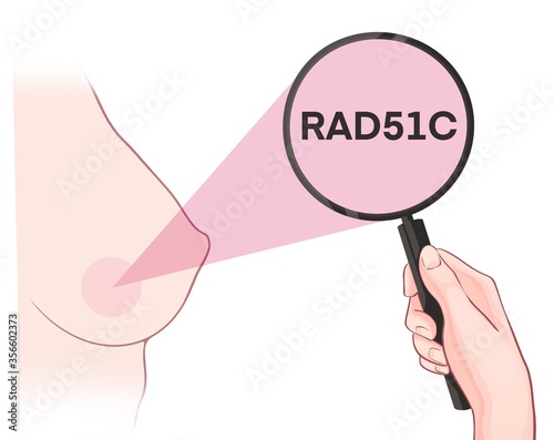 Variants in the RAD51C gene are associated with an increased risk of developing breast cancer
