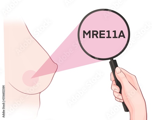 Variants in the MRE11A gene are associated with an increased risk of developing breast cancer