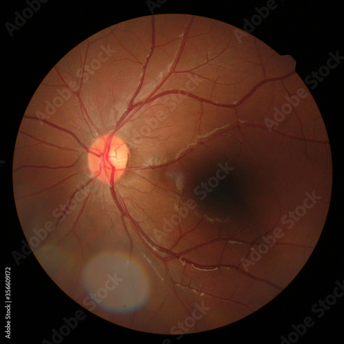 retinal image