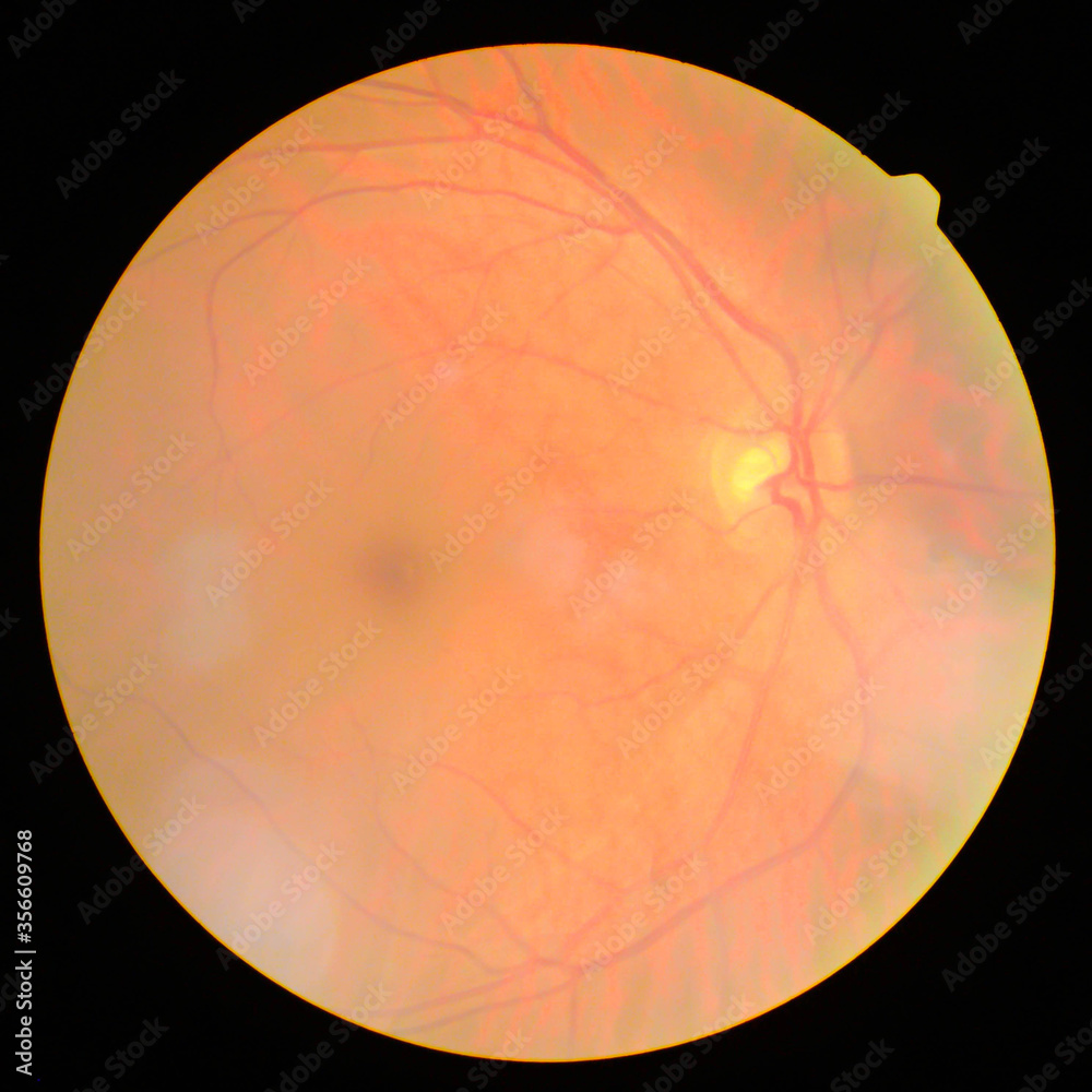 retinal