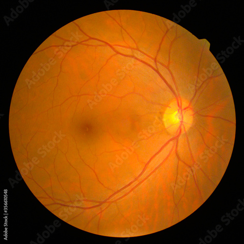 retinal