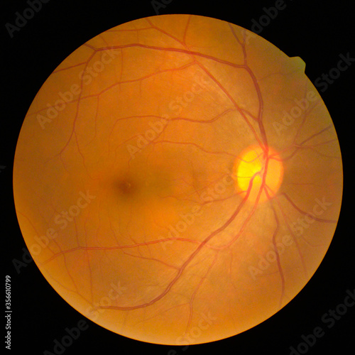retinal