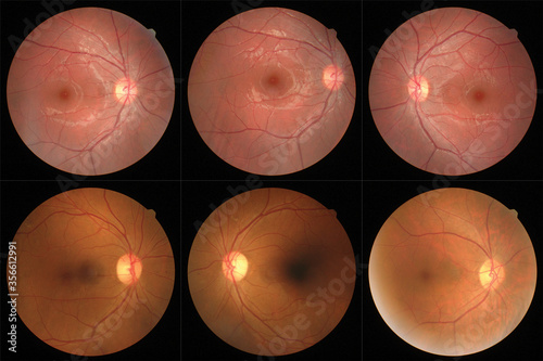 retinal images