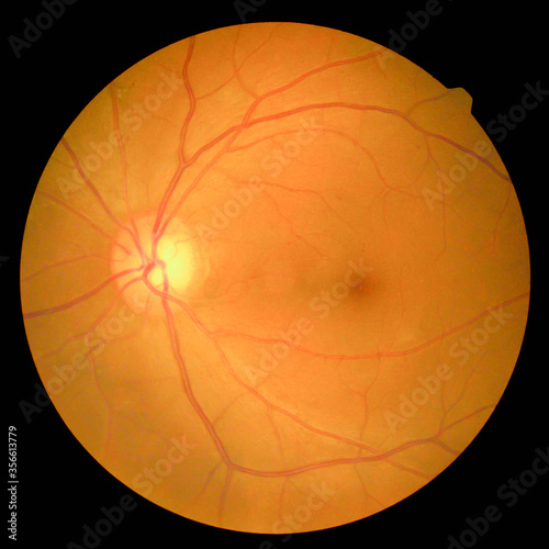 retinal