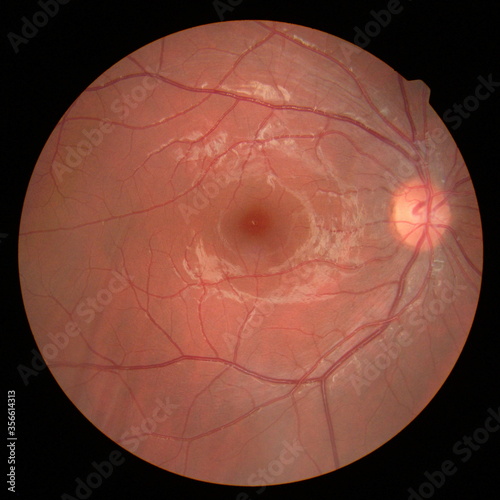 retinal