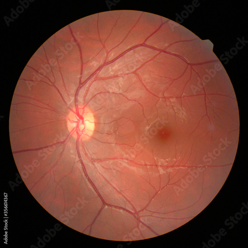 retinal