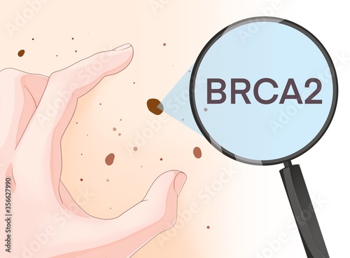 Variants in the BRCA2 gene are associated with an increased risk of developing melanoma 